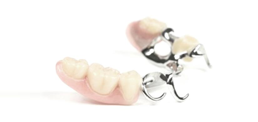 Gaumenplatte zahnersatz Eine Zahnprothese